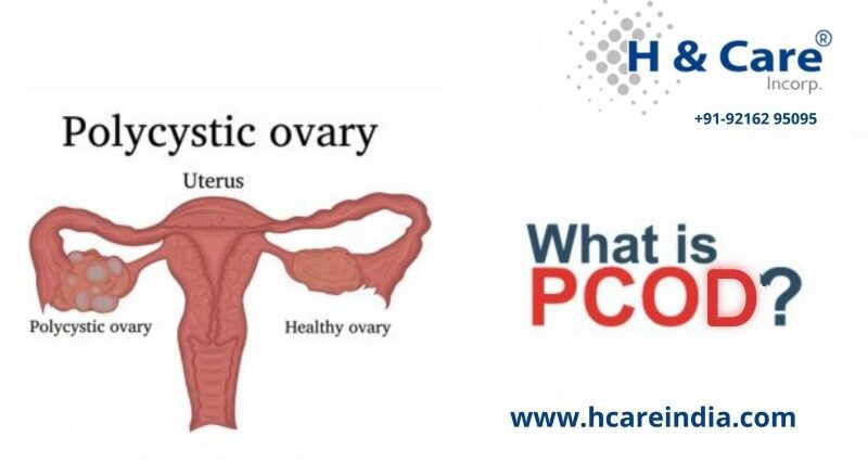 PCOD (Polycystic Ovary Disease)